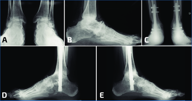 Tobillo Rx Rayos X de Tobillo AP con Estrés en Dorsiflexión - Vizua