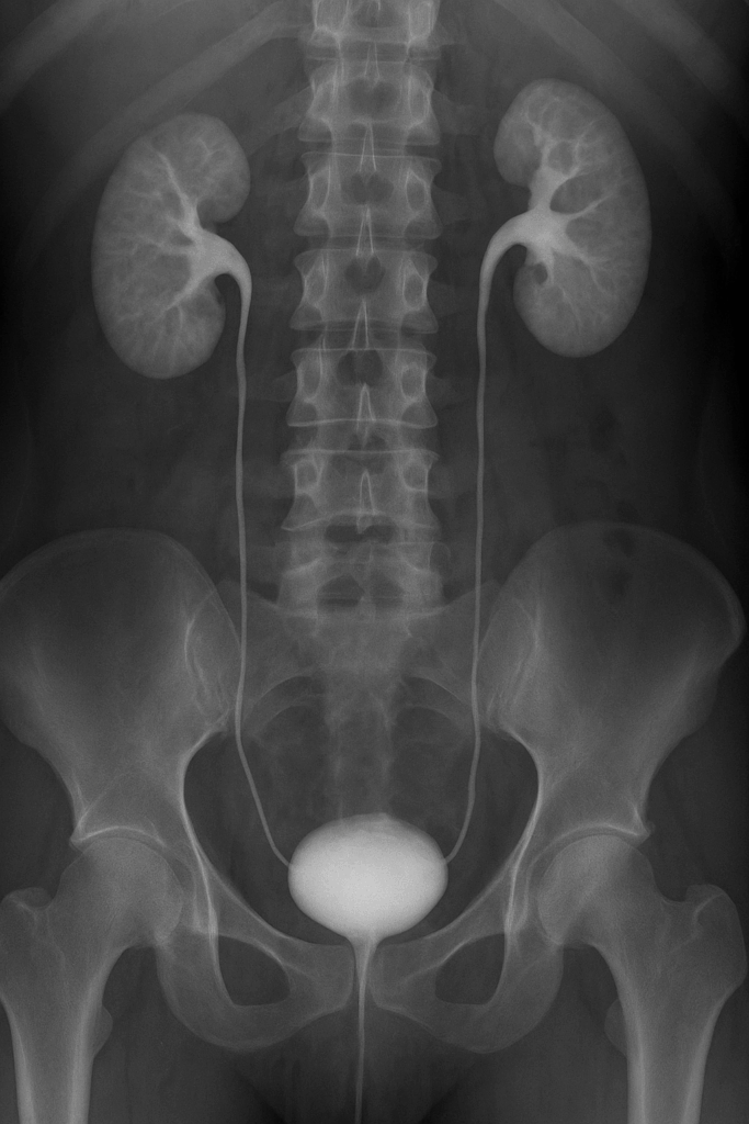 Pielograma intravenoso